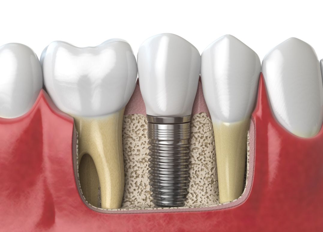 dental implants fargo